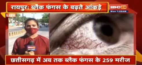 ब्लैक फंगस ने बढ़ाई चिंता, छत्तीसगढ़ में अब तक 259 की पुष्टि, 21 की मौत, सबसे ज्यादा दुर्ग में सामने आए मरीज