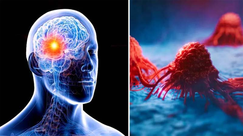 brain_tumer1.jpg