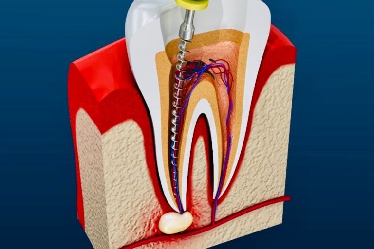 20250908142308_root canal